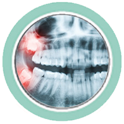 Our dentists specialize in wisdom teeth removal.